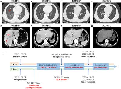 An unresectable and metastatic intrahepatic cholangiocarcinoma with EML4-ALK rearrangement achieving partial response after first-line treatment with ensartinib: a case report